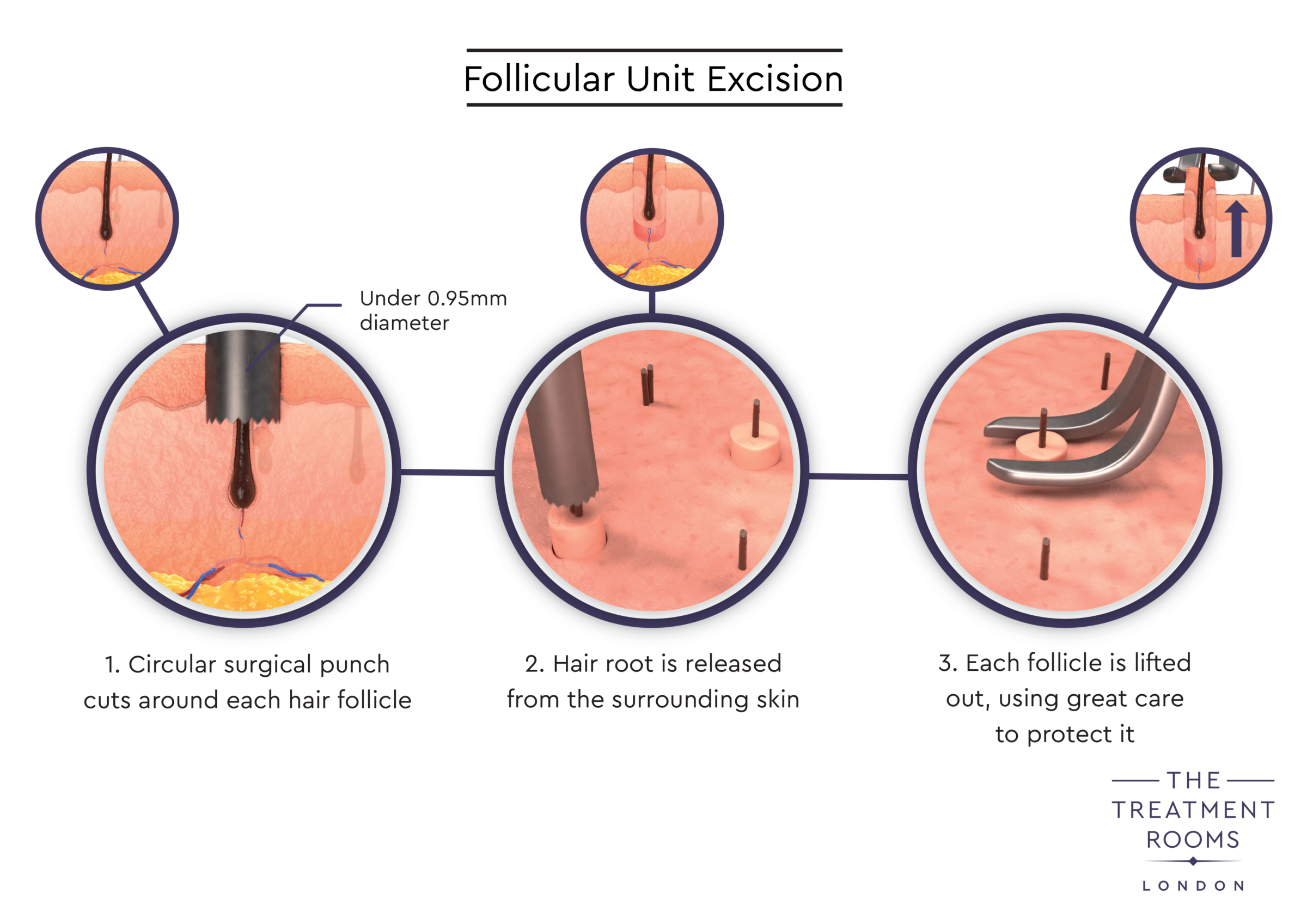 01 TR Extraction v04