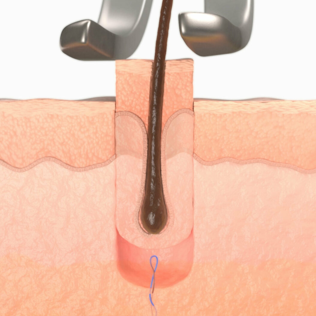 Close-up of a hair follicle from Treatment Rooms 3D hair restoration film. Beeston Media video production bristol science and technology video production higher education video production.